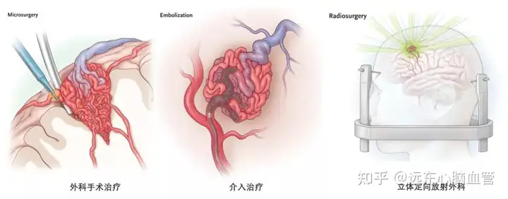 脑血管畸形：藏在脑中的“不定时炸弹”(图4)