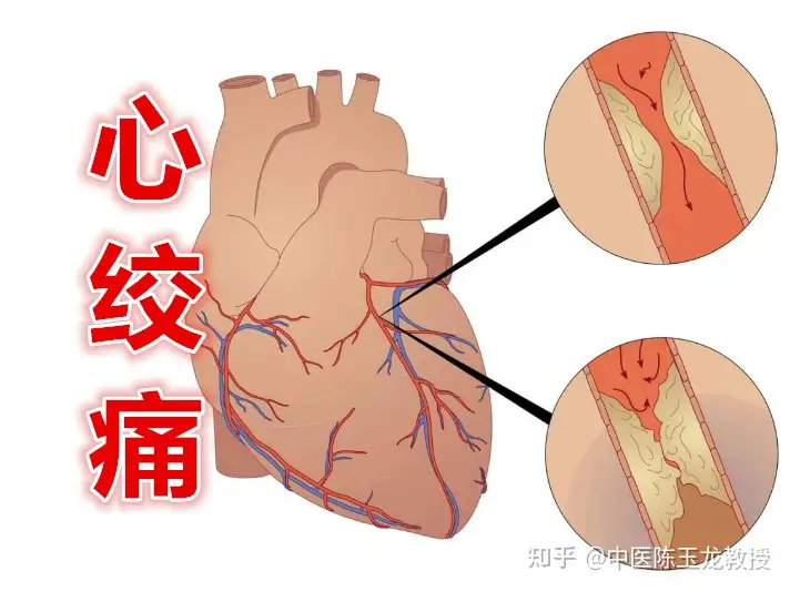 分享几个治疗心绞痛的方子，希望对大家有所帮(图6)