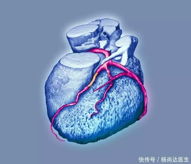 心脏放了支架也不发心绞痛了，为什么还要长期(图1)