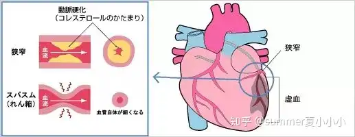 别让心梗猝然夺命，了解心肌梗塞的治疗方法(图3)