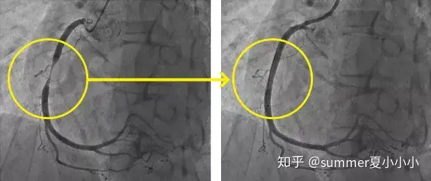 别让心梗猝然夺命，了解心肌梗塞的治疗方法(图10)