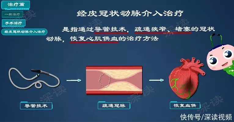 治心梗开刀还是吃药？硝酸甘油能救命？心肌梗(图5)