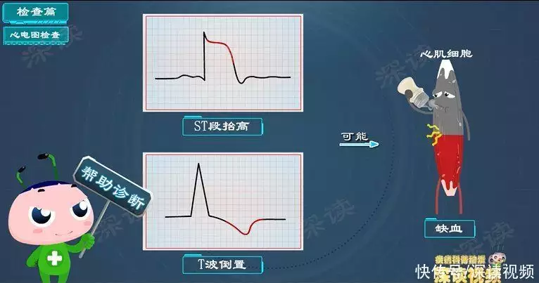 治心梗开刀还是吃药？硝酸甘油能救命？心肌梗(图1)