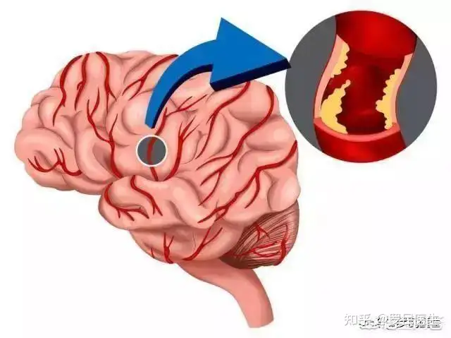 高血压如何治疗？(图1)