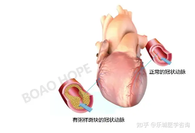 冠心病应该怎么办？(图2)