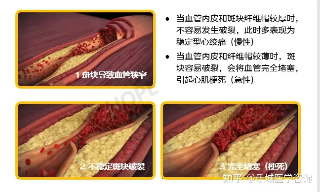 冠心病应该怎么办？(图4)