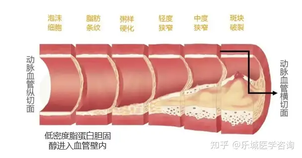 冠心病应该怎么办？(图3)