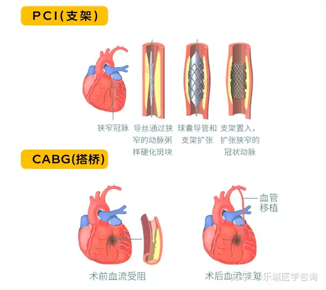 冠心病应该怎么办？(图7)