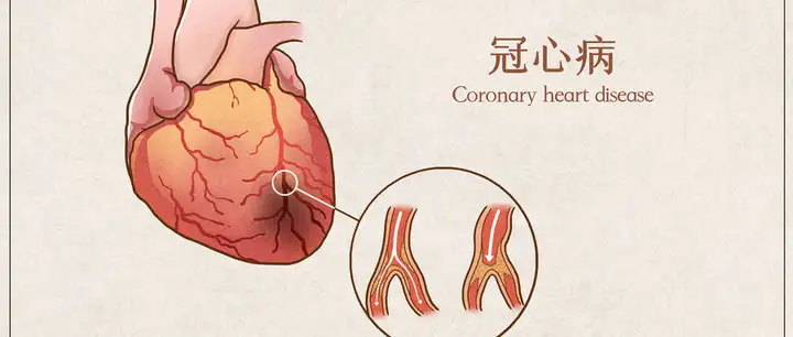 冠心病真的很可怕吗？做好这五点，轻松预防冠(图1)