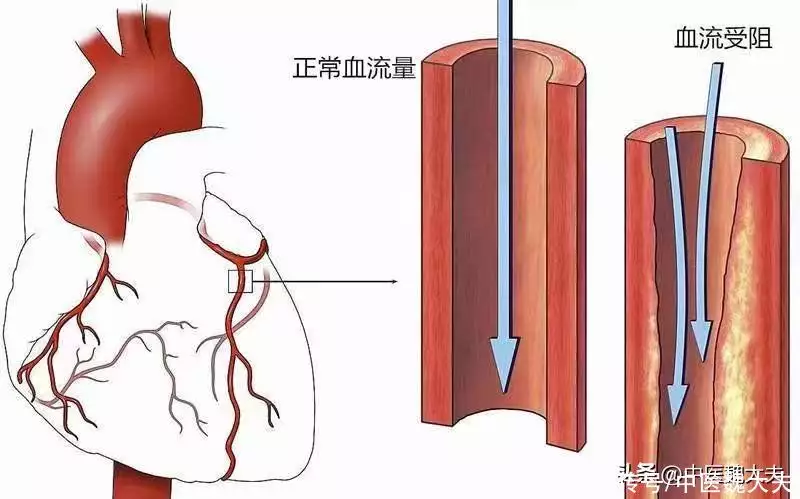 冠心病患者可以运动吗？如何通过科学运动做好(图3)