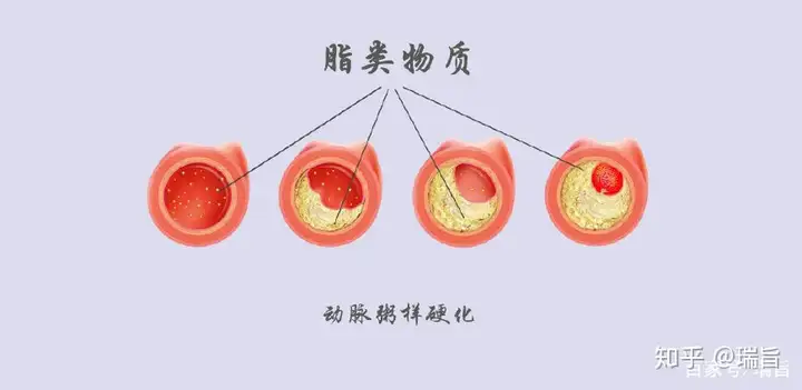 太全了！动脉粥样硬化的治疗方法都在这里！(图1)