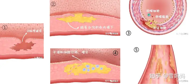 请问怎样防止动脉粥样硬化？(图2)