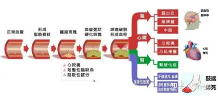 请问怎样防止动脉粥样硬化？(图5)