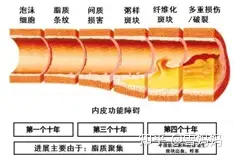 请问怎样防止动脉粥样硬化？(图3)