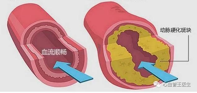 缺乏维生素导致动脉硬化加重？预防需要吃维生(图2)