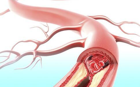 动脉硬化日常该如何进行预防？齐鲁壹点2019-06(图1)
