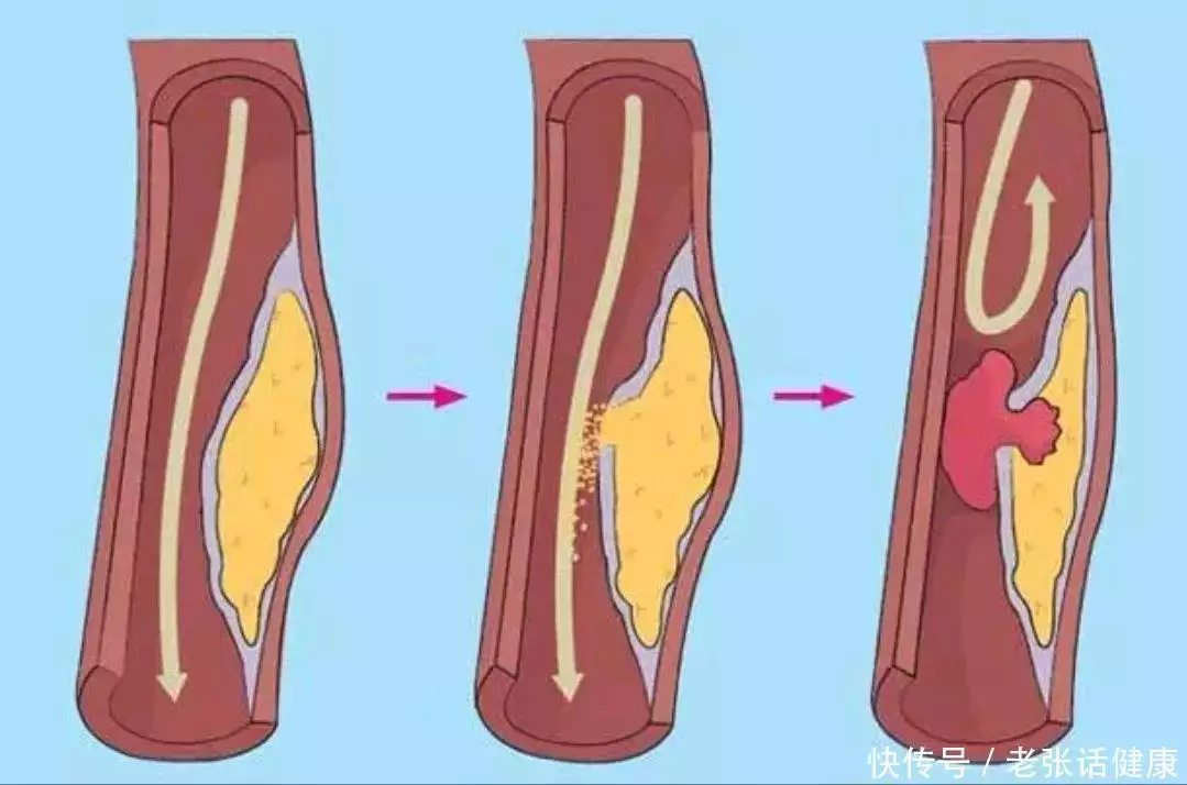 4种食物堪称“胆固醇”大户，想要预防动脉粥样(图1)