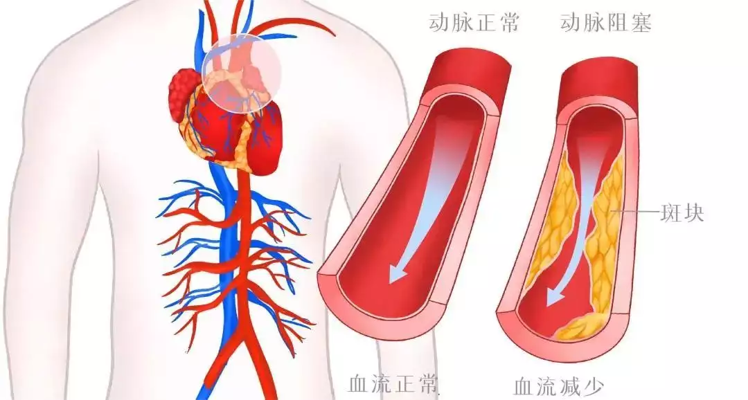 这种食物吃多了，竟让血管里面“长石头”，比(图2)