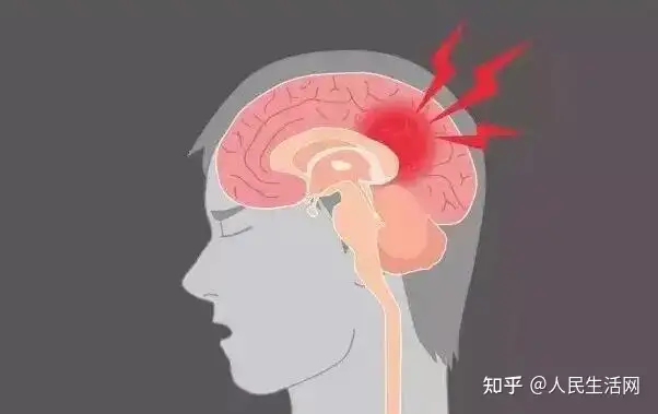 脑出血怎么治疗？把握好这几点会有好的效果！(图1)