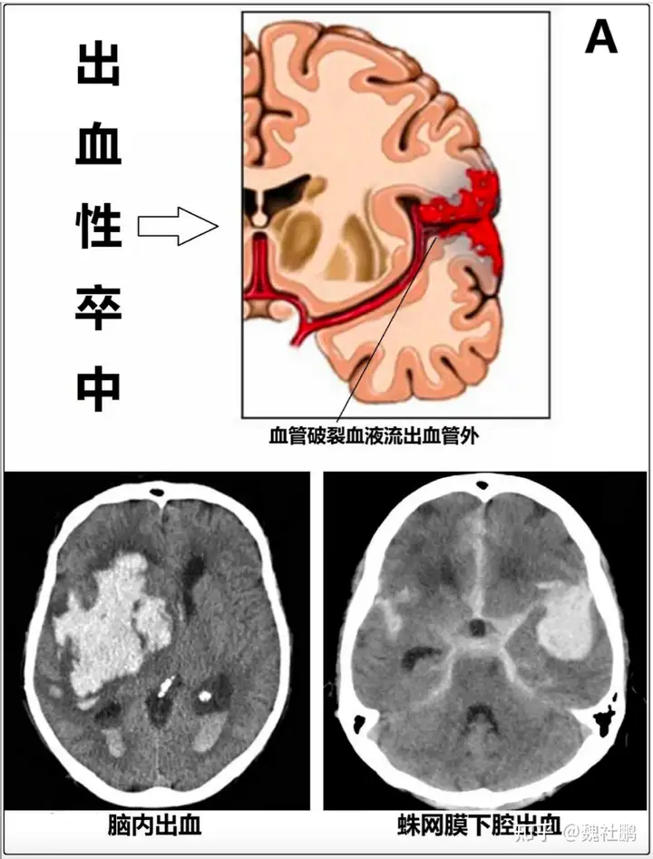 脑出血怎么治?(图1)