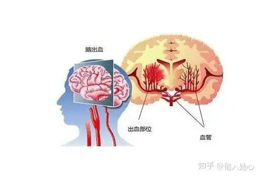 脑出血怎么治疗？想了解情况的看过来，看过来(图1)