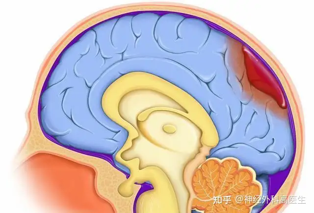 脑子出血怎么办？(图1)