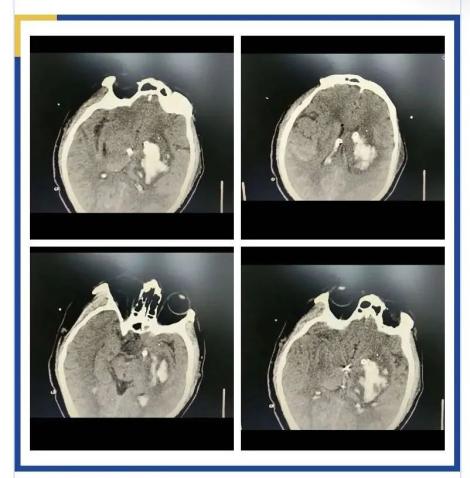 万一脑出血了，正规诊疗流程你知道吗？(图5)