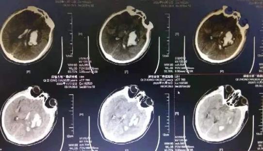 万一脑出血了，正规诊疗流程你知道吗？(图3)