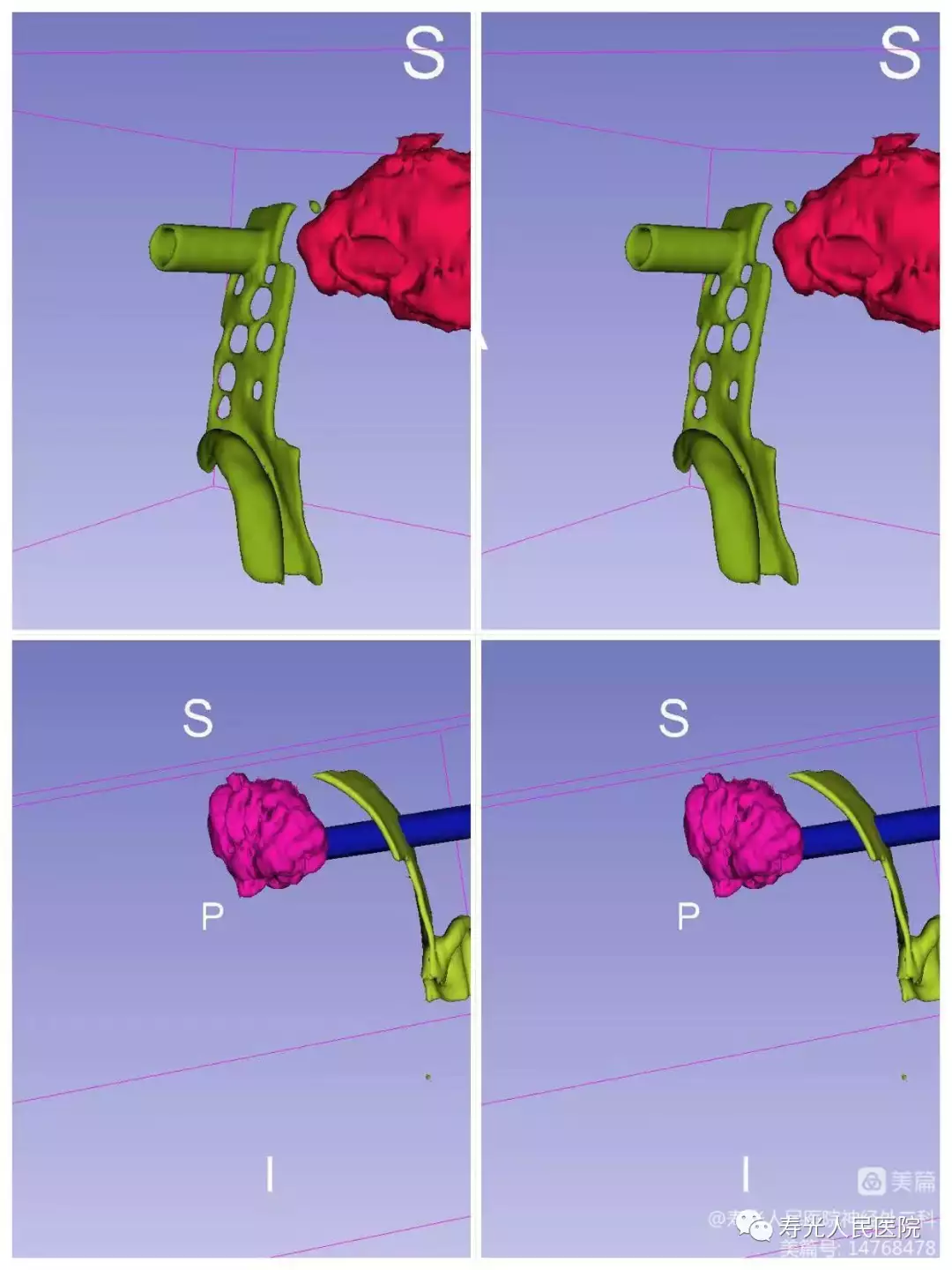 寿光市人民医院神经外科成功完成一例3D-Slicer软(图3)