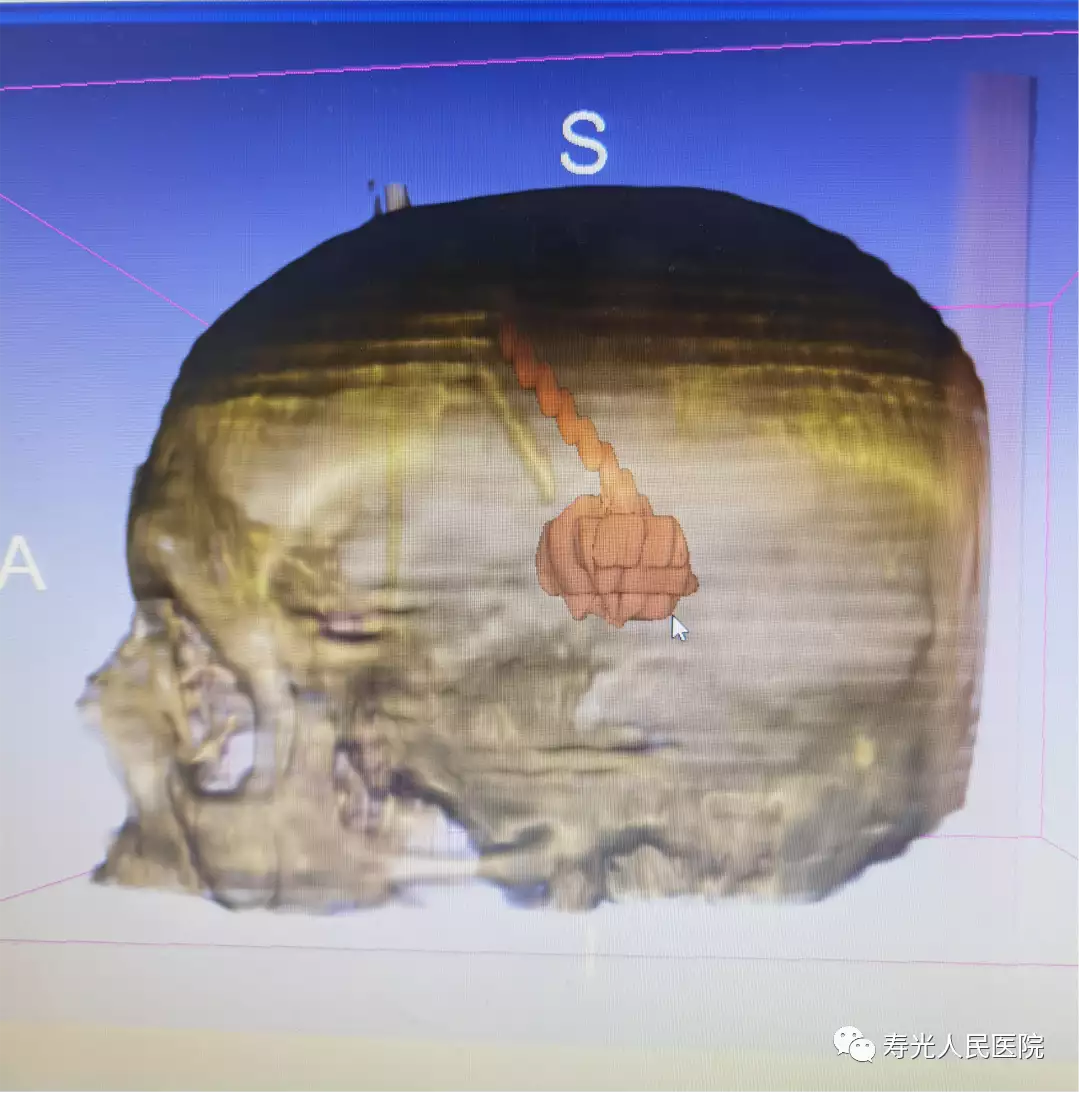 寿光市人民医院神经外科成功完成一例3D-Slicer软(图6)