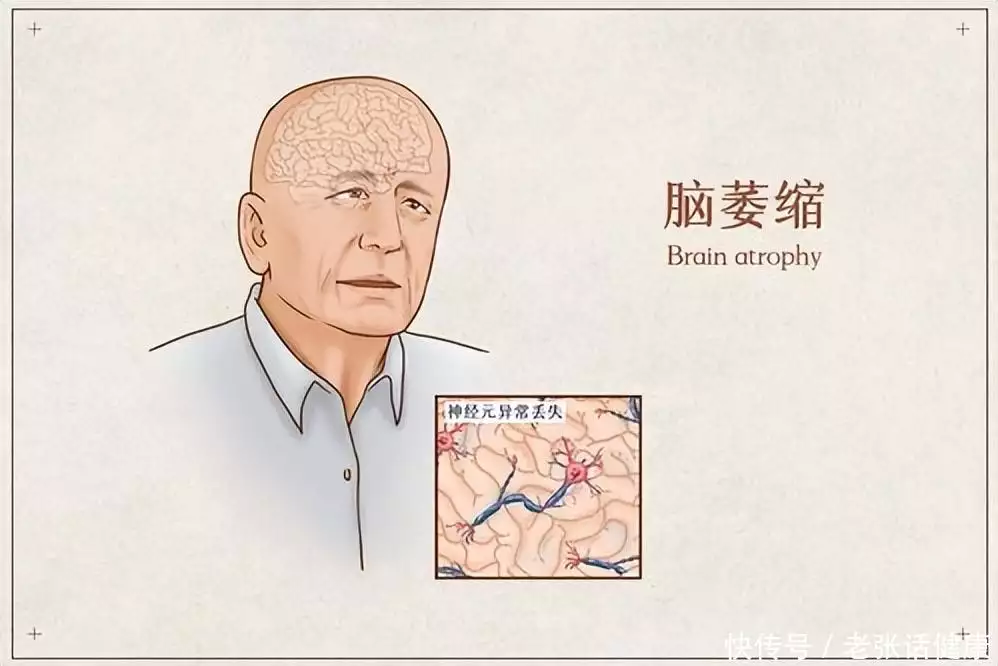 为啥年纪大的人容易得“脑萎缩”？这种病该怎(图1)