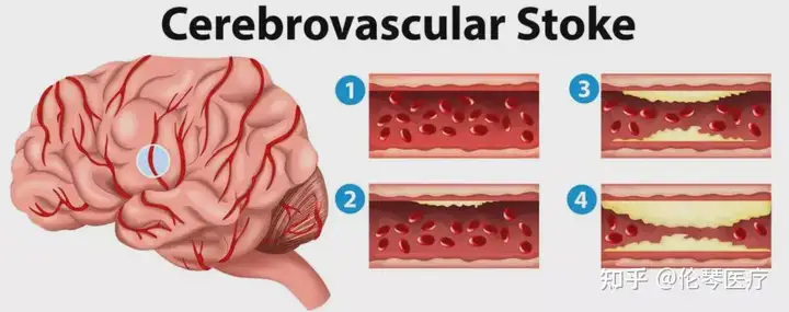 为什么中国人脑血管发病率很高？怎么可以帮助(图4)