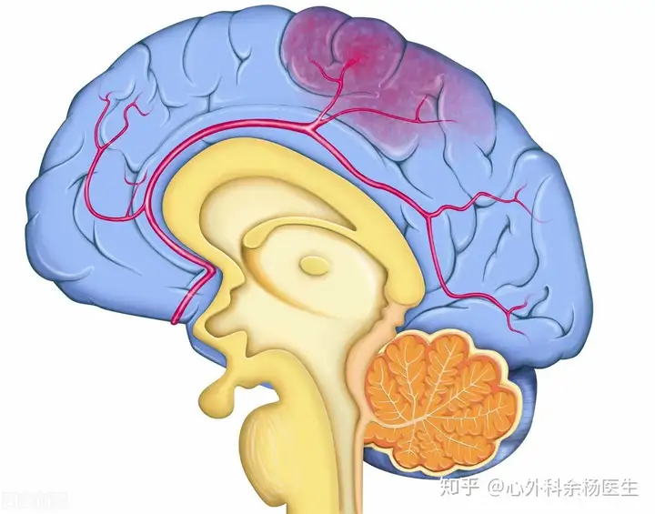 如今脑血管突发疾病，越来越年轻化，我们应该(图2)