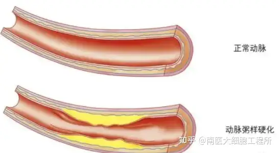 心脑血管疾病怎样治疗？(图1)