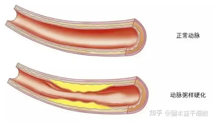 心脑血管疾病应该如何治疗？(图3)