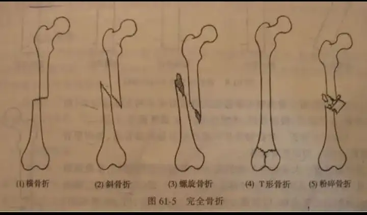 关于骨折你知多少？(图2)