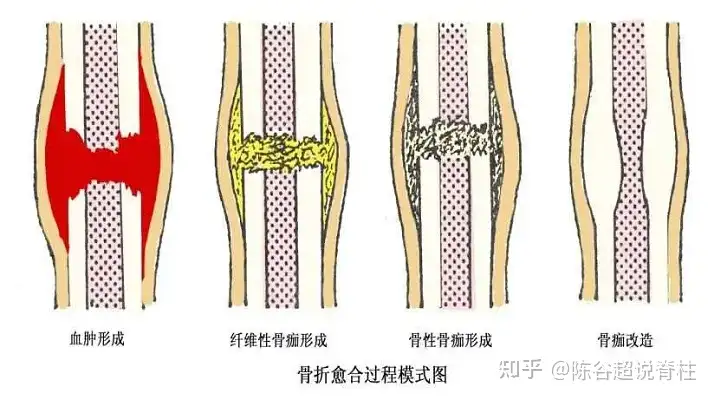 骨折了怎么办?早治疗，好好保养(图2)