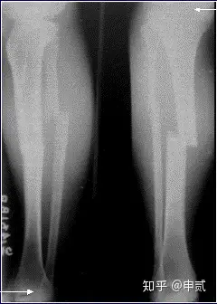 你了解骨折吗？(图7)