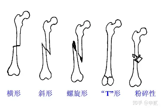 你了解骨折吗？(图14)