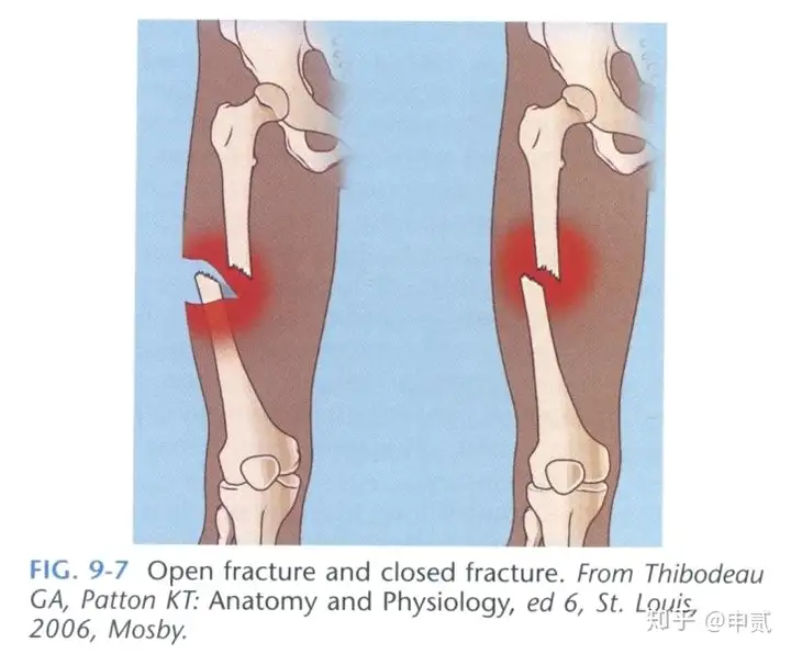 你了解骨折吗？(图18)