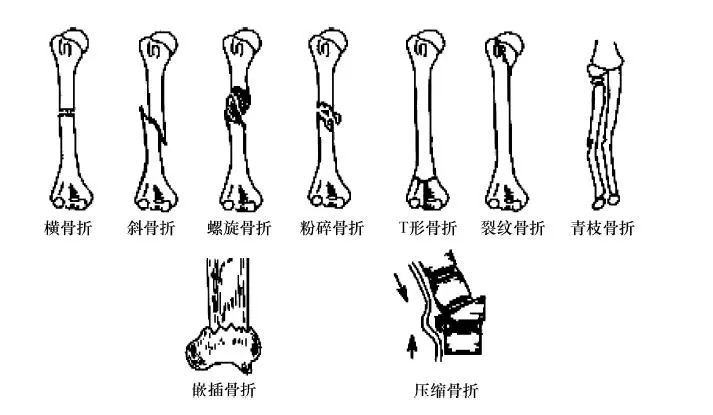 “伤筋动骨一百天”到底有没有科学依据？靠喝(图2)