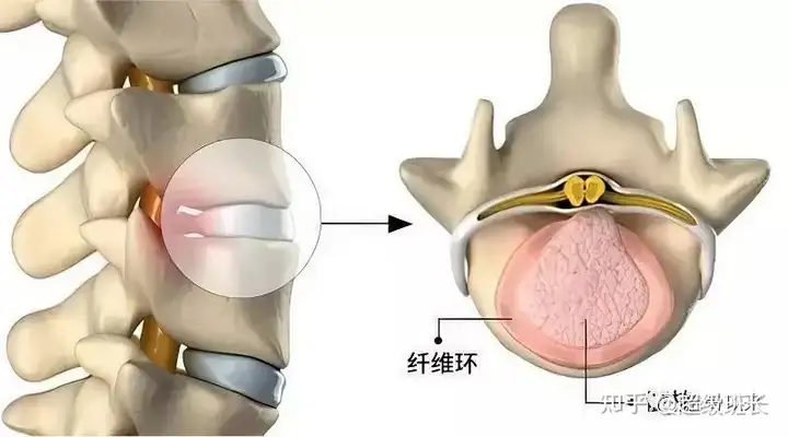 腰椎间盘突出症诊断方案及治疗方法（完整版）(图6)