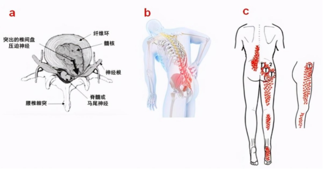 【浦东医生话养生】得了腰椎间盘突出症怎么办(图5)