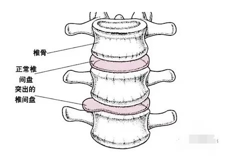 腰椎间盘突出到底能治好吗？(图3)