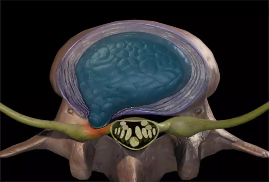 腰椎间盘突出到底能治好吗？(图2)