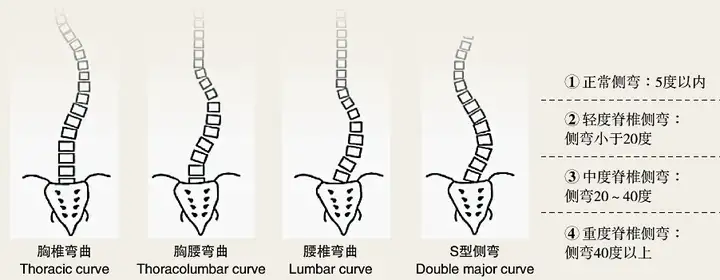 什么是脊柱侧弯(图3)