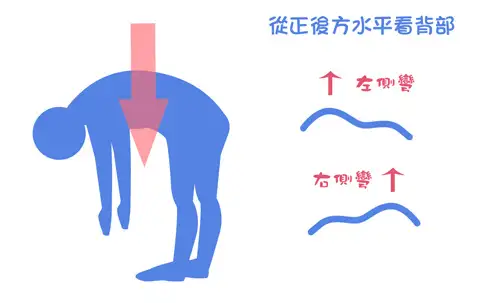 脊柱侧弯的简介和案例分析(图4)