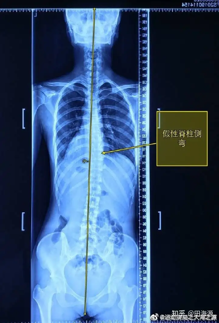 脊柱侧弯大全集一篇搞定(图1)