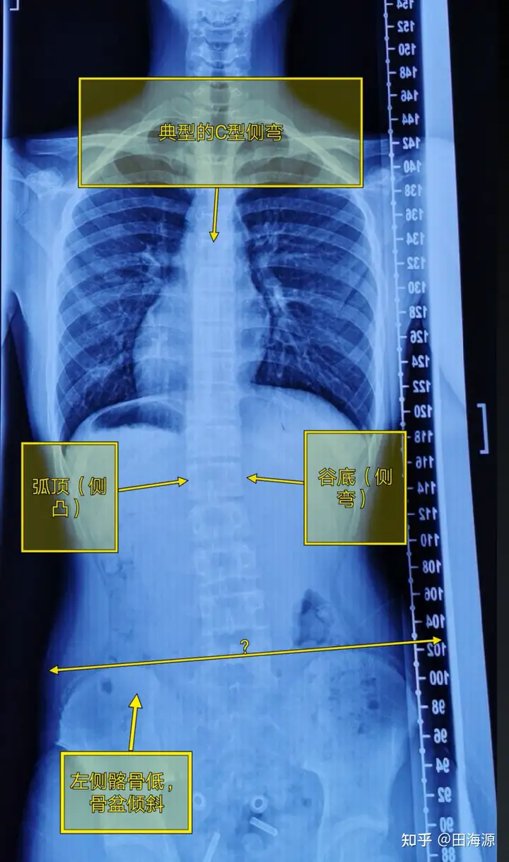 脊柱侧弯大全集一篇搞定(图5)
