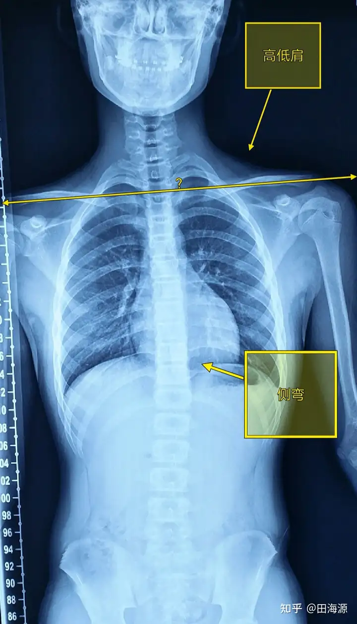 脊柱侧弯大全集一篇搞定(图7)